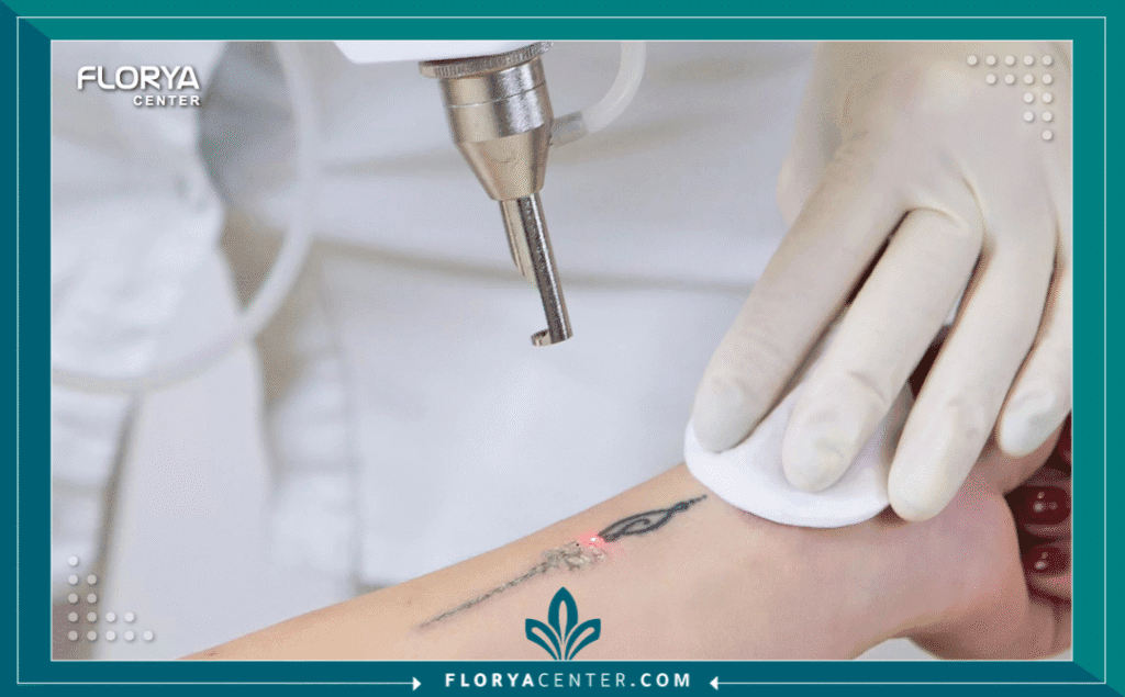 نسخة من Hayaalaje12 20250905 160329 ٠٠٠٠ - طبيب إزالة الوشم في تركيا أصبح الوشم جزءاً شائعاً من التعبير عن الذات، ولكن مع مرور الوقت، قد تتغير الأذواق أو الظروف، مما يدفع الكثيرين للبحث عن إزالة آمنة وفعالة. هنا يبدأ التحدي الحقيقي: العثور على أفضل طبيب إزالة الوشم في تركيا. مع ازدهار قطاع السياحة العلاجية في اسطنبول وأنقرة وغيرها، أصبحت تركيا مركزاً عالمياً لإجراءات الليزر المتقدمة.