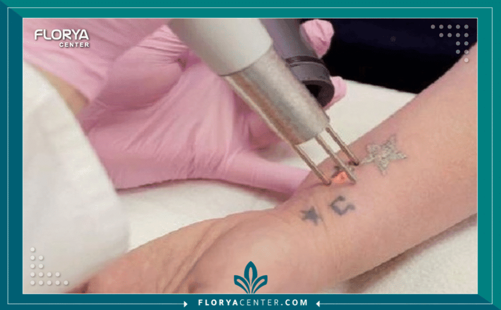 نسخة من Hayaalaje12 20250905 160401 ٠٠٠٠ - طبيب إزالة الوشم في تركيا أصبح الوشم جزءاً شائعاً من التعبير عن الذات، ولكن مع مرور الوقت، قد تتغير الأذواق أو الظروف، مما يدفع الكثيرين للبحث عن إزالة آمنة وفعالة. هنا يبدأ التحدي الحقيقي: العثور على أفضل طبيب إزالة الوشم في تركيا. مع ازدهار قطاع السياحة العلاجية في اسطنبول وأنقرة وغيرها، أصبحت تركيا مركزاً عالمياً لإجراءات الليزر المتقدمة.