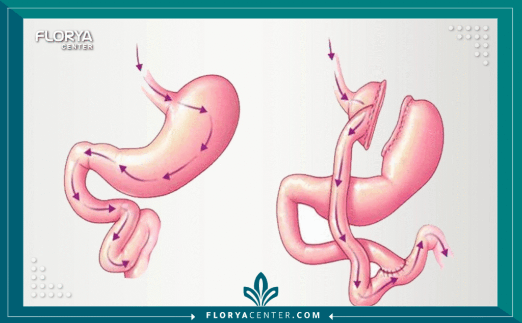 تكلفة عملية تحويل المسار 2 a1 4 - تكلفة عملية تحويل المسار تخيل اللحظة التي تستيقظ فيها كل صباح وأنت تشعر بأنك أخف، وأقوى، وأكثر قدرة على الاستمتاع بالحياة. هذه اللحظة ليست حلماً بعيد المنال، بل هي نتيجة لقرار شجاع تتخذه اليوم. تعتبر تكلفة عملية تحويل المسار في تركيا بوابتك الأسرع نحو هذا التحول الجذري.