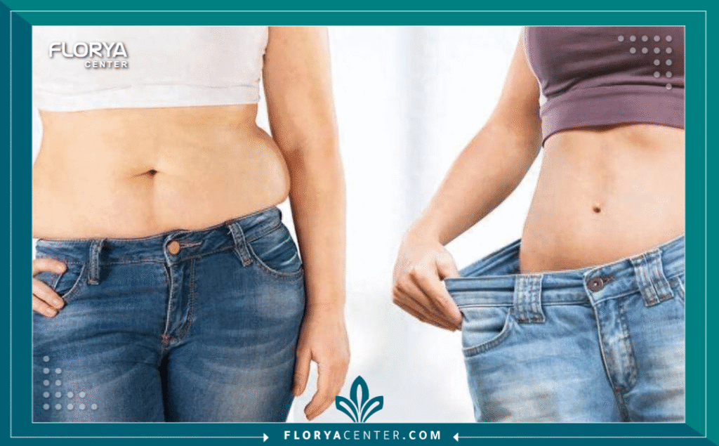 a1 - عمليات السمنة في تركيا تعد عمليات السمنة في تركيا نقطة تحول حاسمة في حياة الأفراد الذين يخوضون معركة طويلة الأمد مع الوزن الزائد. إنها ليست مجرد إجراء تجميلي، بل هي خطوة علاجية فعالة تُقدم حلاً مستداماً لمشكلة صحية عالمية معقدة. عندما تصبح الحمية الغذائية والتمارين الرياضية غير كافية لتحقيق نتائج صحية ملموسة، تبرز جراحة علاج البدانة (Bariatric Surgery) كأداة قوية لاستعادة السيطرة على الصحة وبدء فصل جديد من الحياة.