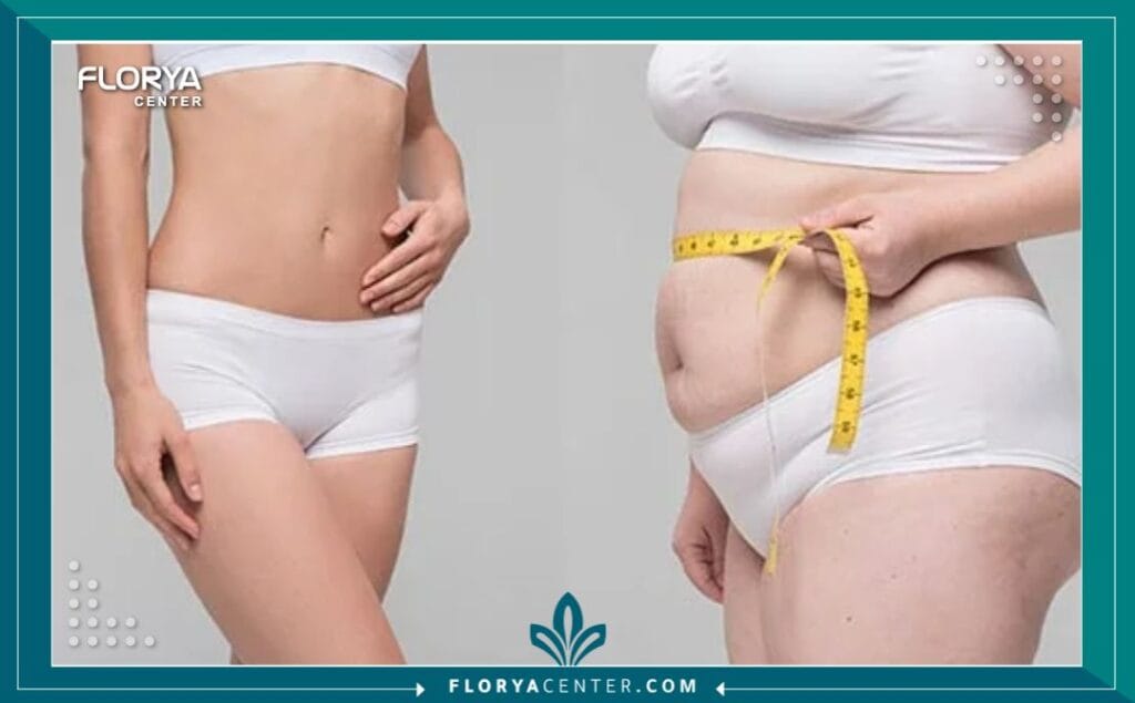 a2 6 - عمليات السمنة في تركيا تعد عمليات السمنة في تركيا نقطة تحول حاسمة في حياة الأفراد الذين يخوضون معركة طويلة الأمد مع الوزن الزائد. إنها ليست مجرد إجراء تجميلي، بل هي خطوة علاجية فعالة تُقدم حلاً مستداماً لمشكلة صحية عالمية معقدة. عندما تصبح الحمية الغذائية والتمارين الرياضية غير كافية لتحقيق نتائج صحية ملموسة، تبرز جراحة علاج البدانة (Bariatric Surgery) كأداة قوية لاستعادة السيطرة على الصحة وبدء فصل جديد من الحياة.