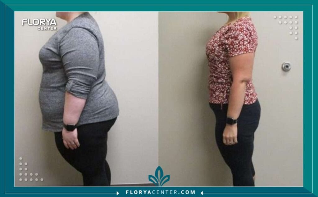 b1 6 - أقل وزن لعملية تكميم المعدة هل تبحث عن بداية جديدة لحياة أكثر صحة؟ إن أقل وزن لعملية تكميم المعدة (Gastric Sleeve Surgery) ليس مجرد رقم على الميزان، بل هو مفتاح لفهم ما إذا كان هذا الإجراء هو الخطوة الصحيحة نحو تحقيق أهدافك الصحية. في هذا الدليل، سنستكشف المعايير الطبية الدقيقة التي تحدد أهلية الفرد لعملية التكميم، بعيداً عن المفاهيم الشائعة، لنقدم لك رؤية واضحة وموثوقة.