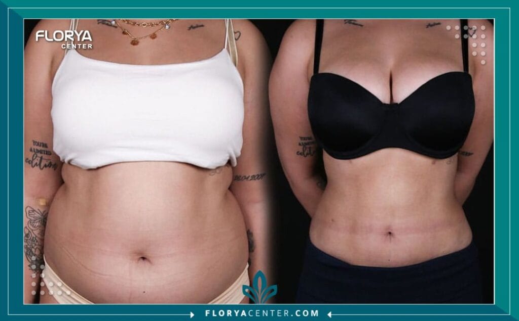 b2 7 - نزول الوزن بعد تكميم المعدة يُعد نزول الوزن بعد تكميم المعدة الخطوة الأهم في رحلة استعادة الصحة والرشاقة، وهي ليست مجرد عملية جراحية، بل هي نقطة تحول جذرية نحو نمط حياة جديد. في عالم يتسارع فيه البحث عن حلول فعالة للسمنة، تبرز عملية تكميم المعدة (Sleeve Gastrectomy) كواحدة من أكثر الإجراءات أماناً وفعالية. لا يقتصر الأمر على الأرقام التي تظهر على الميزان، بل يمتد ليشمل استعادة الثقة بالنفس، والشفاء من الأمراض المرتبطة بالسمنة، والقدرة على عيش الحياة بطاقة متجددة. إن فهمك الدقيق للجدول الزمني، والتحديات، والنتائج المتوقعة هو مفتاحك الأساسي لضمان نجاح هذه الرحلة.