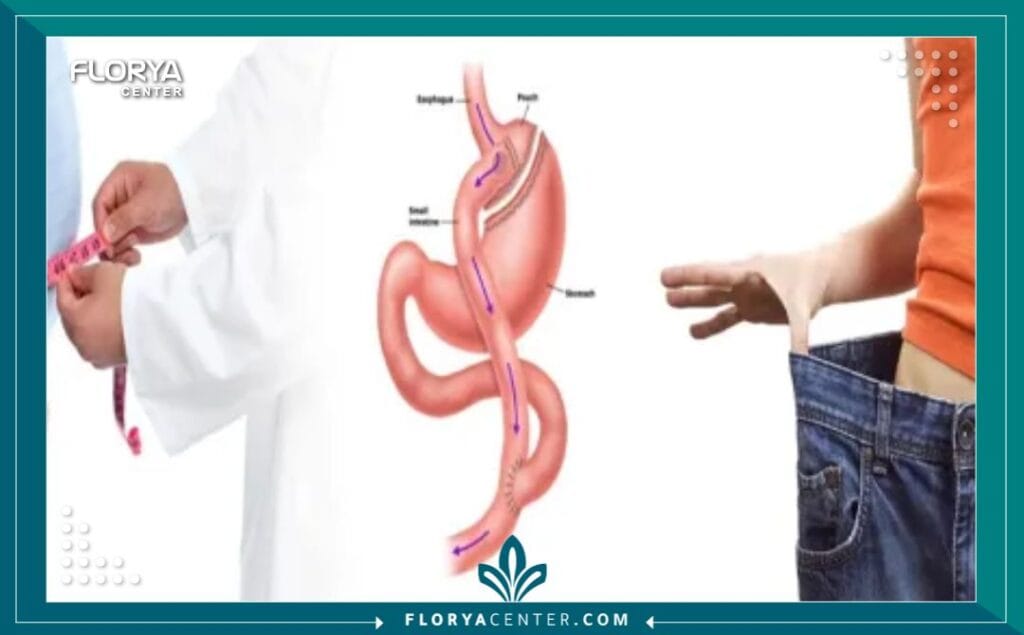b3 1 - تحويل المسار تُعد جراحة تحويل المسار (Gastric Bypass) - وتحديداً تقنية Roux-en-Y - واحدة من أكثر الإجراءات الجراحية المعتمدة والفعالة عالمياً في مكافحة السمنة المفرطة والأمراض المصاحبة لها. عندما تفشل الحميات الغذائية والتمارين الرياضية في تحقيق فقدان وزن مستدام لدى الأفراد الذين يعانون من مؤشر كتلة جسم (BMI) مرتفع، يصبح عملية تحويل مسار المعدة هو الأداة الجراحية التي تقدم أملاً حقيقياً في استعادة جودة الحياة والصحة العامة.