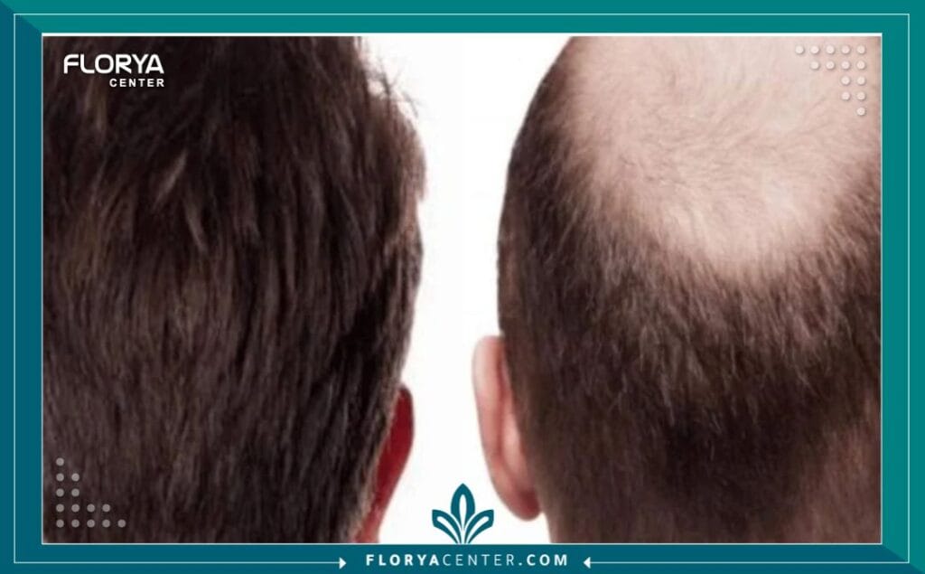 b3 - أسعار عمليات زراعة الشعر في اسطنبول البحث عن حل لمشكلة تساقط الشعر هو رحلة شخصية محفوفة بالأمل والتساؤلات، وفي طليعتها يأتي السؤال عن أسعار عمليات زراعة الشعر في اسطنبول (Hair Transplant Costs in Istanbul). لا تقتصر زراعة الشعر على كونها إجراءً تجميلياً فحسب، بل هي استثمار في الثقة بالنفس واستعادة المظهر الشبابي. لقد أصبحت إسطنبول، بفضل خبرتها الطبية الهائلة وتكاليفها التنافسية، العاصمة العالمية لهذا الإجراء. هذا الدليل الشامل والمفصّل، المُعد بالامتثال الكامل لأعلى معايير الخبرة والموثوقية (E-E-A-T)، سيأخذك خطوة بخطوة لفهم كل ما يتعلق بـ أسعار عمليات زراعة الشعر في اسطنبول وما يجب أن تتوقعه من رحلتك العلاجية. نحن هنا في مركز فلوريا لنضمن لك الشفافية الكاملة والنتائج الأفضل.