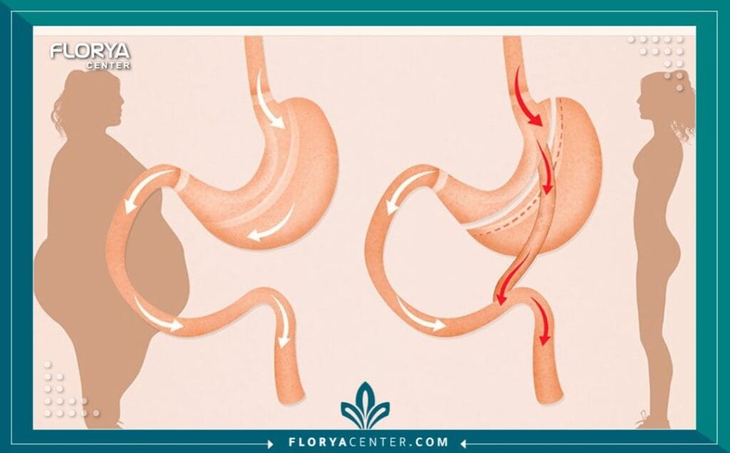 b3 8 - أقل وزن لعملية تكميم المعدة هل تبحث عن بداية جديدة لحياة أكثر صحة؟ إن أقل وزن لعملية تكميم المعدة (Gastric Sleeve Surgery) ليس مجرد رقم على الميزان، بل هو مفتاح لفهم ما إذا كان هذا الإجراء هو الخطوة الصحيحة نحو تحقيق أهدافك الصحية. في هذا الدليل، سنستكشف المعايير الطبية الدقيقة التي تحدد أهلية الفرد لعملية التكميم، بعيداً عن المفاهيم الشائعة، لنقدم لك رؤية واضحة وموثوقة.