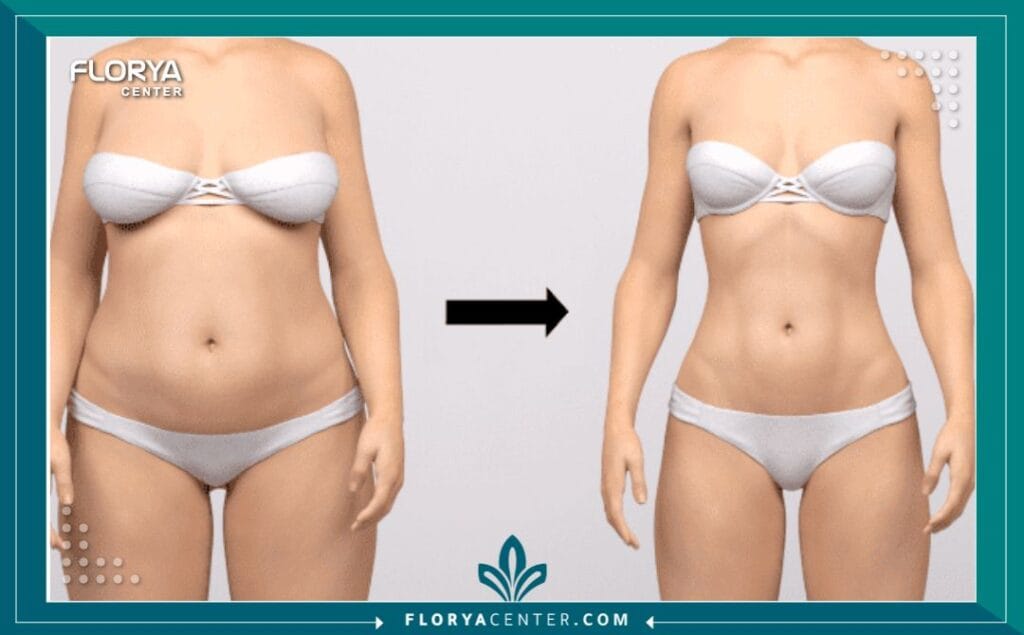 b3 9 - نزول الوزن بعد تكميم المعدة يُعد نزول الوزن بعد تكميم المعدة الخطوة الأهم في رحلة استعادة الصحة والرشاقة، وهي ليست مجرد عملية جراحية، بل هي نقطة تحول جذرية نحو نمط حياة جديد. في عالم يتسارع فيه البحث عن حلول فعالة للسمنة، تبرز عملية تكميم المعدة (Sleeve Gastrectomy) كواحدة من أكثر الإجراءات أماناً وفعالية. لا يقتصر الأمر على الأرقام التي تظهر على الميزان، بل يمتد ليشمل استعادة الثقة بالنفس، والشفاء من الأمراض المرتبطة بالسمنة، والقدرة على عيش الحياة بطاقة متجددة. إن فهمك الدقيق للجدول الزمني، والتحديات، والنتائج المتوقعة هو مفتاحك الأساسي لضمان نجاح هذه الرحلة.