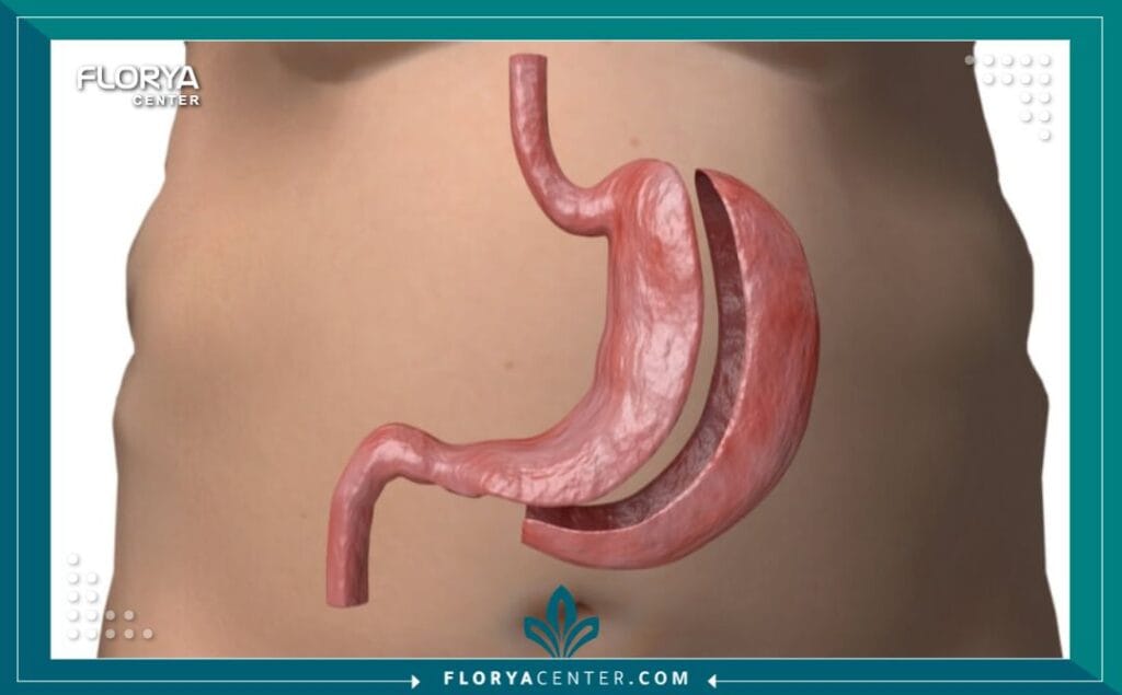 c1 4 - مخاطر عملية تكميم المعدة تُعد السمنة المفرطة مرضاً مزمناً يهدد حياة الملايين حول العالم، مما يدفع الكثيرين للبحث عن حلول جراحية جذرية لاستعادة الصحة والثقة بالنفس. وتتصدر عملية تكميم المعدة (Gastric Sleeve) قائمة هذه الحلول نظراً لفعاليتها العالية، ولكن، كما هو الحال مع أي تدخل جراحي، يبقى الهاجس الأكبر للمرضى هو الخوف من مخاطر عملية تكميم المعدة. إن فهم هذه المخاطر ليس مدعاة للذعر، بل هو الخطوة الأولى نحو اتخاذ قرار مستنير وآمن.