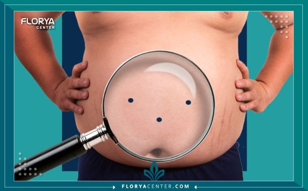 c3 4 - تدبيس المعدة يُعد إجراء تدبيس المعدة (Bariatric Surgery / Stomach Stapling) ثورة حقيقية في عالم جراحات السمنة، وهو ليس مجرد عملية لإنقاص الوزن، بل هو خطوة أولى نحو حياة جديدة مليئة بالصحة والحيوية. في ظل التحديات التي تفرضها السمنة المفرطة وتأثيرها على جودة الحياة، يبرز تدبيس المعدة كحل جذري وفعال يقدم أملاً متجدداً للملايين. هذا الإجراء لا يقتصر على تغيير مظهرك، بل يمتد ليغير علاقتك بالطعام ويعيد برمجة صحتك الأيضية. إن اتخاذ قرار الخضوع لعملية تدبيس المعدة هو قرار مصيري، ومع التقدم الطبي الهائل، أصبحت تقنيات تدبيس المعدة أكثر أماناً وفعالية من أي وقت مضى، مما يفتح الباب أمام نتائج مذهلة ومستدامة.