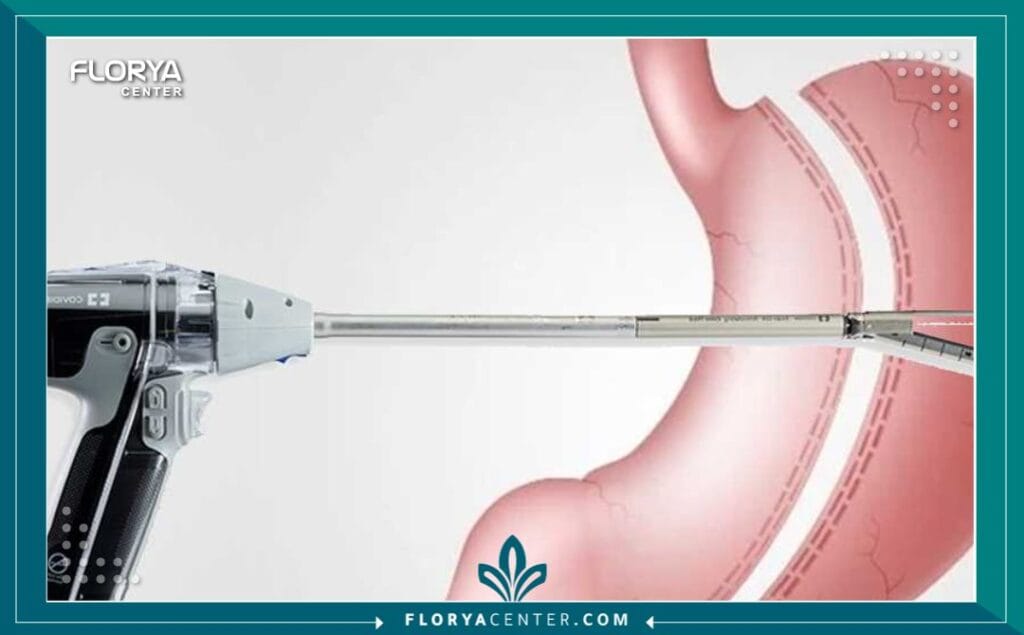 c4 4 - تدبيس المعدة يُعد إجراء تدبيس المعدة (Bariatric Surgery / Stomach Stapling) ثورة حقيقية في عالم جراحات السمنة، وهو ليس مجرد عملية لإنقاص الوزن، بل هو خطوة أولى نحو حياة جديدة مليئة بالصحة والحيوية. في ظل التحديات التي تفرضها السمنة المفرطة وتأثيرها على جودة الحياة، يبرز تدبيس المعدة كحل جذري وفعال يقدم أملاً متجدداً للملايين. هذا الإجراء لا يقتصر على تغيير مظهرك، بل يمتد ليغير علاقتك بالطعام ويعيد برمجة صحتك الأيضية. إن اتخاذ قرار الخضوع لعملية تدبيس المعدة هو قرار مصيري، ومع التقدم الطبي الهائل، أصبحت تقنيات تدبيس المعدة أكثر أماناً وفعالية من أي وقت مضى، مما يفتح الباب أمام نتائج مذهلة ومستدامة.