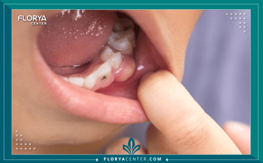 nouralagee93@gmail.com 20250904 131150 ٠٠٠٠ - أعراض خراج الأسنان تُعد أعراض خراج الأسنان (Dental Abscess) من أكثر التجارب إيلاماً وإلحاحاً في طب الأسنان، فهي ليست مجرد ألم أسنان بسيط، بل إنذار واضح بوجود عدوى بكتيرية حادة تتطلب تدخلاً طبياً فورياً. يتكون خراج السن كجيب من القيح (صديد) نتيجة لعدوى بكتيرية، إما في طرف جذر السن أو في اللثة بجانب الجذر. إن فهم طبيعة أعراض خراج الأسنان هو الخطوة الأولى لتجنب المضاعفات الخطيرة التي قد تتجاوز الفم لتصل إلى مجرى الدم أو حتى الدماغ. إن تجاهل هذه الأعراض لا يؤدي أبداً إلى الشفاء التلقائي، بل يضمن تفاقم العدوى. في "مركز فلوريا"، نتعامل مع أعراض خراج الأسنان كأولوية قصوى، مدركين أن كل دقيقة تفرق في إنقاذ السن ومنع انتشار العدوى.