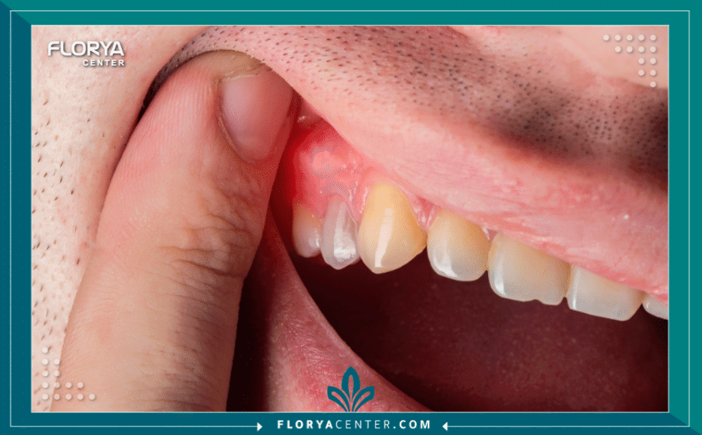 nouralagee93@gmail.com 20250904 131229 ٠٠٠٠ - أعراض خراج الأسنان تُعد أعراض خراج الأسنان (Dental Abscess) من أكثر التجارب إيلاماً وإلحاحاً في طب الأسنان، فهي ليست مجرد ألم أسنان بسيط، بل إنذار واضح بوجود عدوى بكتيرية حادة تتطلب تدخلاً طبياً فورياً. يتكون خراج السن كجيب من القيح (صديد) نتيجة لعدوى بكتيرية، إما في طرف جذر السن أو في اللثة بجانب الجذر. إن فهم طبيعة أعراض خراج الأسنان هو الخطوة الأولى لتجنب المضاعفات الخطيرة التي قد تتجاوز الفم لتصل إلى مجرى الدم أو حتى الدماغ. إن تجاهل هذه الأعراض لا يؤدي أبداً إلى الشفاء التلقائي، بل يضمن تفاقم العدوى. في "مركز فلوريا"، نتعامل مع أعراض خراج الأسنان كأولوية قصوى، مدركين أن كل دقيقة تفرق في إنقاذ السن ومنع انتشار العدوى.