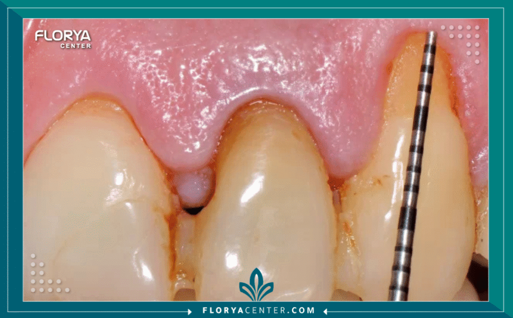 nouralagee93@gmail.com 20250906 131709 ٠٠٠٠ - أسباب انحسار اللثة يُعد فهم أسباب انحسار اللثة الخطوة الأولى والأساسية نحو استعادة ابتسامة صحية وواثقة. إنها ليست مجرد مشكلة تجميلية تؤثر على تناسق الابتسامة، بل هي حالة طبية تقدمية تُعرف بانحسار اللثة (Gum Recession)، حيث تبدأ أنسجة اللثة المحيطة بالأسنان بالانكماش أو التراجع، مما يؤدي إلى كشف المزيد من السن أو جذر السن. هذا الكشف لا يسبب فقط حساسية مؤلمة للأسنان، بل يفتح الباب أمام تراكم البكتيريا الخطيرة، مما قد يؤدي في النها Bية إلى تلف العظام الداعمة وفقدان الأسنان.