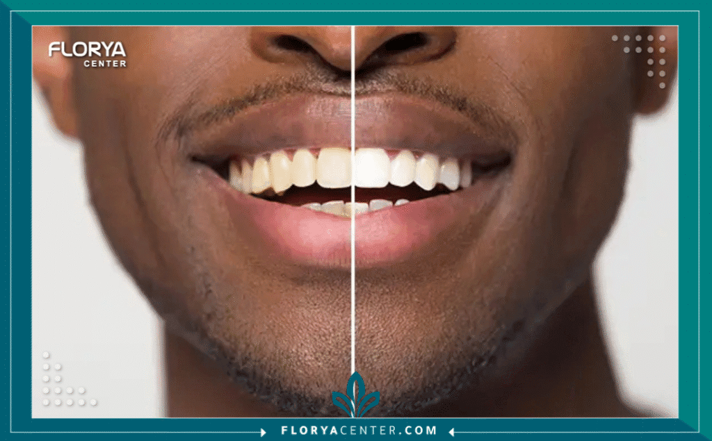 nouralagee93@gmail.com 20250907 232604 ٠٠٠٠ - أفضل طرق تبييض الأسنان إن البحث عن أفضل طرق تبييض الأسنان لم يعد مجرد رفاهية تجميلية، بل أصبح ضرورة اجتماعية ومهنية تعكس الصحة والثقة بالنفس. تعتبر الابتسامة الناصعة هي المفتاح الأول للانطباعات الدائمة، ومع تطور تقنيات طب الأسنان التجميلي، بات الحصول على أسنان بيضاء كاللؤلؤ إجراءً آمناً وسريعاً ومتاحاً للجميع، خاصة في وجهات عالمية مثل تركيا التي تجمع بين الجودة الطبية والأسعار التنافسية.