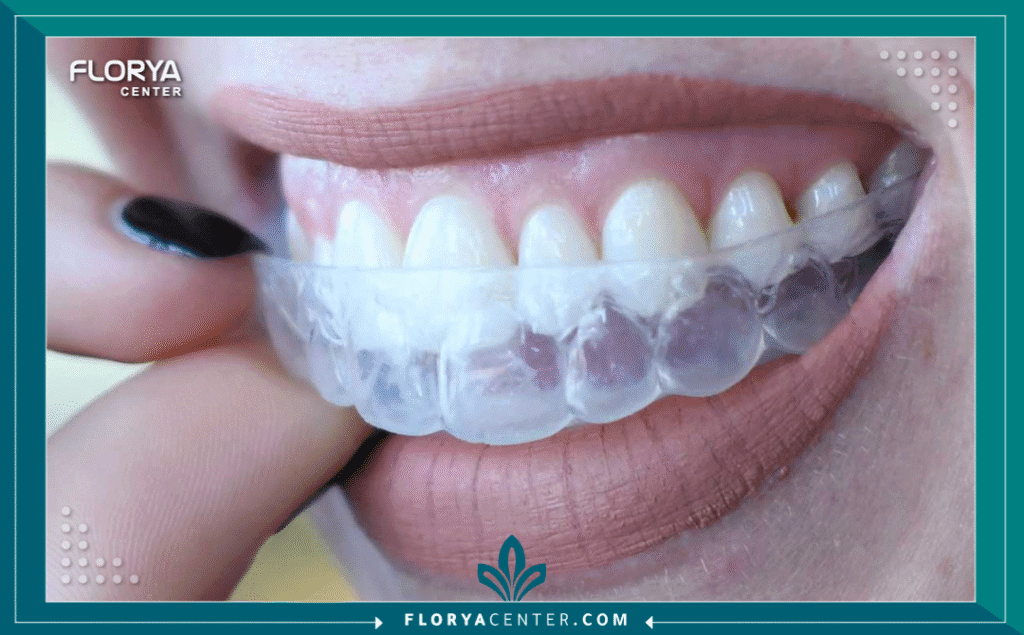 nouralagee93@gmail.com 20250908 075012 ٠٠٠٠ - قوالب تبييض الأسنان المنزلية تُعد قوالب تبييض الأسنان المنزلية (Home Teeth Whitening Trays) واحدة من أكثر الحلول فعالية وشعبية لاستعادة الابتسامة البيضاء الناصعة، وهي تمثل حلاً وسطاً مثالياً يجمع بين الراحة المنزلية والنتائج الاحترافية. مع تزايد الطلب على الإجراءات التجميلية للأسنان، يبرز هذا الخيار كبديل عملي لتبييض الليزر المكلف في العيادات.