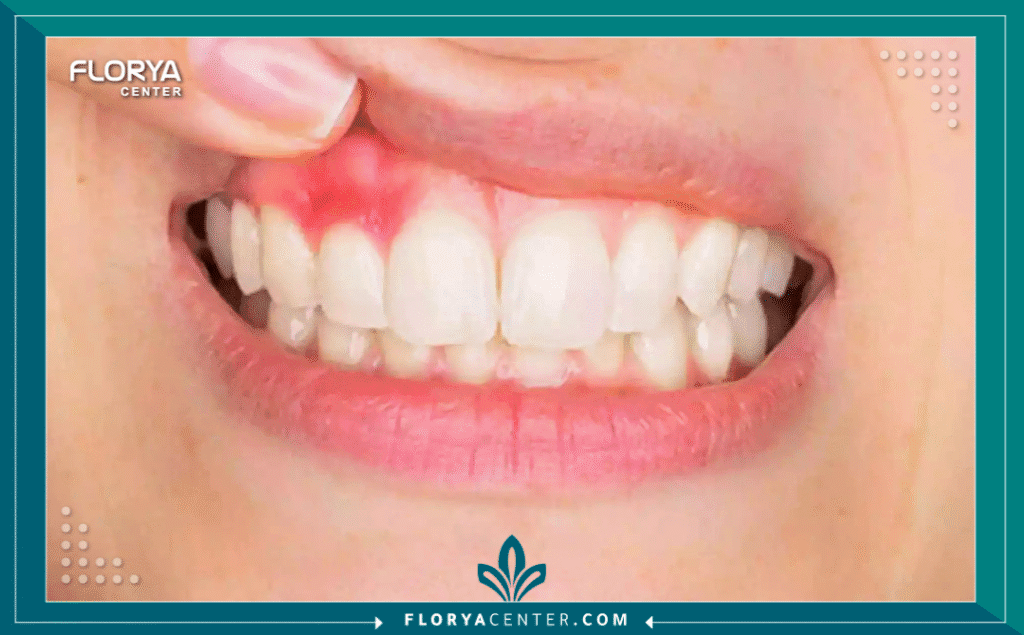 nouralagee93@gmail.com 20250910 105153 ٠٠٠٠ - أضرار تبييض الأسنان تُعد الابتسامة المشرقة إحدى أهم سمات الجاذبية والثقة بالنفس في العصر الحديث، مما جعل الإقبال على طب الأسنان التجميلي في تصاعد مستمر. ومع ذلك، يظل الهاجس الأكبر لدى المرضى هو الخوف من أضرار تبييض الأسنان (Teeth Whitening Risks) وتأثيراتها المحتملة على صحة الفم. إن السعي وراء البياض الناصع قد يتحول إلى تجربة مؤلمة إذا لم يتم اختيار التقنية المناسبة والمركز الطبي الذي يراعي أعلى معايير الأمان الحيوي.