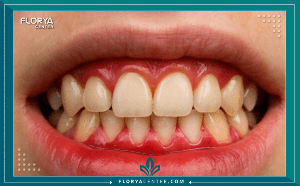 nouralagee93@gmail.com 20250916 200013 ٠٠٠٠ - أسباب التهاب اللثة وعلاجه تمثل أسباب التهاب اللثة وعلاجه محوراً أساسياً في طب الأسنان الحديث، نظراً لكونه واحداً من أكثر أمراض الفم شيوعاً في العالم. إنه ليس مجرد إزعاج بسيط يسبب نزيفاً عند تنظيف الأسنان، بل هو إنذار مبكر وحالة طبية حقيقية تُعرف علمياً باسم (Gingivitis). هذا الالتهاب، الذي تسببه البكتيريا، هو الخطوة الأولى نحو أمراض اللثة الأكثر تدميراً. إن فهم أسباب التهاب اللثة وعلاجه بشكل صحيح هو المفتاح للحفاظ على صحة الفم والوقاية من فقدان الأسنان.