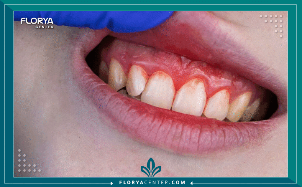 nouralagee93@gmail.com 20250916 200034 ٠٠٠٠ - أسباب التهاب اللثة وعلاجه تمثل أسباب التهاب اللثة وعلاجه محوراً أساسياً في طب الأسنان الحديث، نظراً لكونه واحداً من أكثر أمراض الفم شيوعاً في العالم. إنه ليس مجرد إزعاج بسيط يسبب نزيفاً عند تنظيف الأسنان، بل هو إنذار مبكر وحالة طبية حقيقية تُعرف علمياً باسم (Gingivitis). هذا الالتهاب، الذي تسببه البكتيريا، هو الخطوة الأولى نحو أمراض اللثة الأكثر تدميراً. إن فهم أسباب التهاب اللثة وعلاجه بشكل صحيح هو المفتاح للحفاظ على صحة الفم والوقاية من فقدان الأسنان.