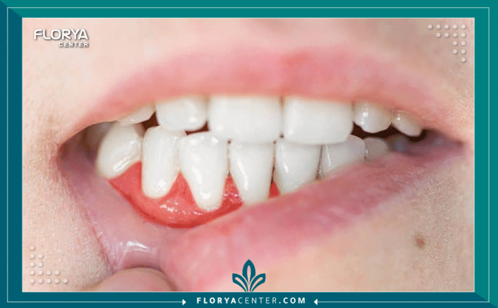 nouralagee93@gmail.com 20250916 200051 ٠٠٠٠ - أسباب التهاب اللثة وعلاجه تمثل أسباب التهاب اللثة وعلاجه محوراً أساسياً في طب الأسنان الحديث، نظراً لكونه واحداً من أكثر أمراض الفم شيوعاً في العالم. إنه ليس مجرد إزعاج بسيط يسبب نزيفاً عند تنظيف الأسنان، بل هو إنذار مبكر وحالة طبية حقيقية تُعرف علمياً باسم (Gingivitis). هذا الالتهاب، الذي تسببه البكتيريا، هو الخطوة الأولى نحو أمراض اللثة الأكثر تدميراً. إن فهم أسباب التهاب اللثة وعلاجه بشكل صحيح هو المفتاح للحفاظ على صحة الفم والوقاية من فقدان الأسنان.