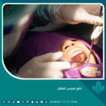 خلع ضرس العقل