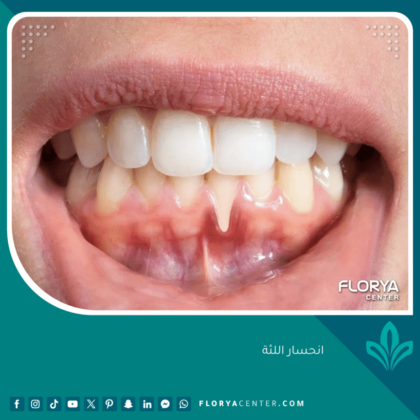 انحسار اللثة