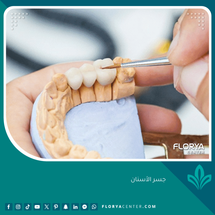 جسر الأسنان