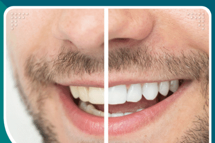 تكلفة تبييض الأسنان