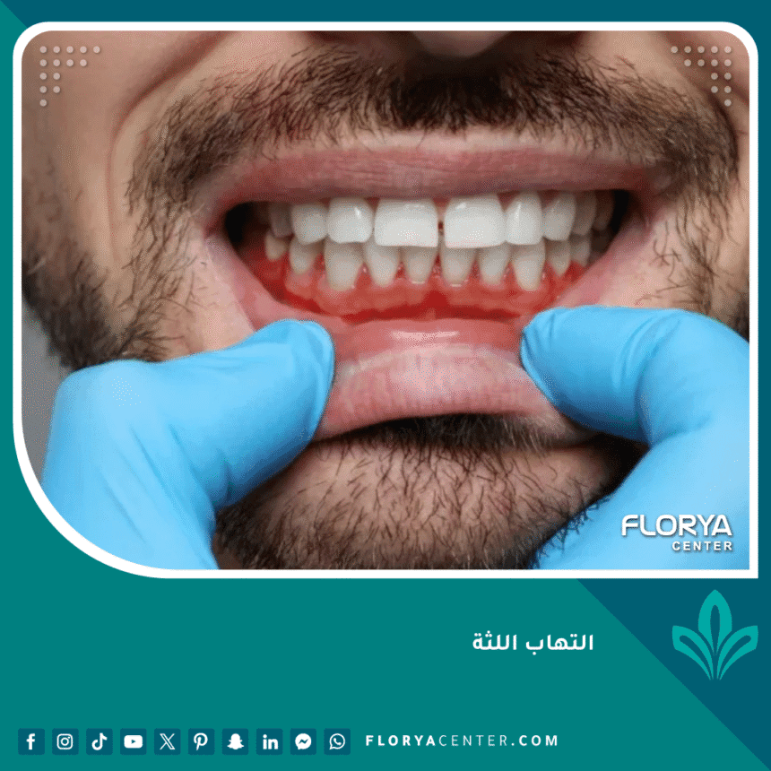 التهاب اللثة