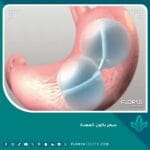 سعر بالون المعدة