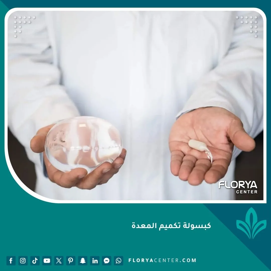 كبسولة تكميم المعدة