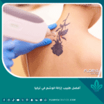 أفضل طبيب إزالة الوشم في تركيا