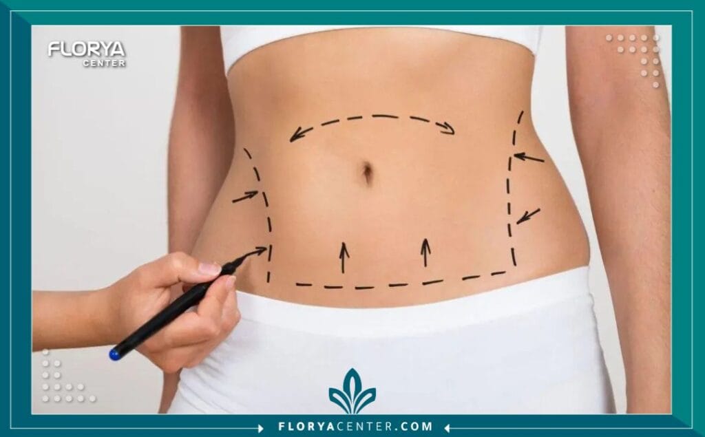 الصور داخل المقالة مها 11 - شفط دهون البطن في تركيا إن السعي للحصول على قوام مثالي ومتناسق يبدأ غالباً من شفط دهون البطن في تركيا، الوجهة التي أثبتت جدارتها عالمياً في دمج الخبرة الطبية المتقدمة مع تجربة علاجية فاخرة. يعاني الكثيرون من تراكم الدهون العنيدة في منطقة البطن، والتي غالباً ما تقاوم الحميات الغذائية القاسية والتمارين الرياضية الشاقة.