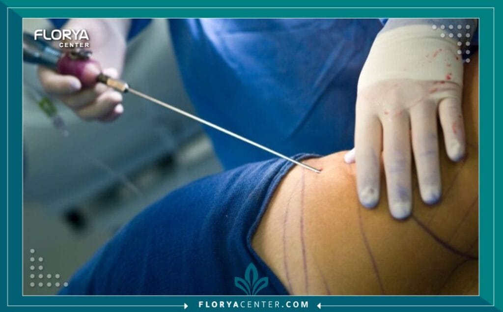 الصور داخل المقالة مها 2 - شفط دهون الفخذين في تركيا إن السعي للحصول على قوام متناسق ومثالي هو رحلة يبحث فيها الكثيرون عن التناغم بين أجزاء الجسم المختلفة. يعتبر إجراء شفط دهون الفخذين في تركيا (Thigh Liposuction) الحل الأمثل والأكثر تقدماً لأولئك الذين يعانون من تراكم الدهون العنيدة في منطقة الفخذين، والتي غالباً ما تقاوم أقسى الحميات الغذائية والتمارين الرياضية. إن إجراء شفط دهون الفخذين في تركيا لا يقتصر على إزالة الدهون فحسب، بل هو فن دقيق لـ نحت الجسم، يهدف إلى استعادة الثقة بالنفس، ومنح الفخذين مظهراً مشدوداً وجذاباً يتناسب مع بقية ملامح الجسم. في عالم اليوم، أصبح الحصول على هذا التناسق ممكناً أكثر من أي وقت مضى، خاصة مع الخبرات الطبية المتقدمة التي تقدمها مراكز رائدة مثل "مركز فلوريا".