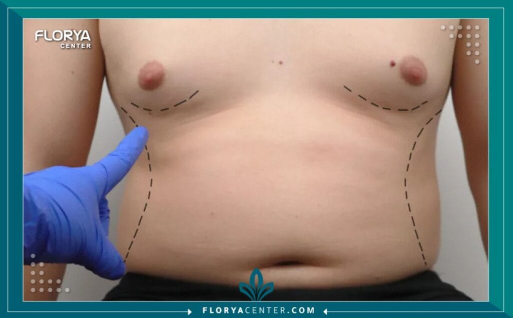 علاج التثدي عند الرجال في تركيا 7 الصور داخل المقالة مها 2025 11 14T110255.542 - علاج التثدي عند الرجال في تركيا أصبح علاج التثدي عند الرجال في تركيا حلاً رائداً للرجال الذين يسعون لاستعادة مظهر الصدر المسطح والرجولي. هذه الظاهرة، التي تتجاوز مجرد مشكلة تجميلية لتؤثر بعمق على الثقة بالنفس، تجد في تركيا مزيجاً مثالياً من الخبرة الطبية المتقدمة والتكاليف التنافسية. لم يعد التثدي (Gynecomastia) مشكلة مستعصية، بل أصبح إجراءً دقيقاً يهدف إلى نحت الجسم واستعادة التناسق الذكوري، مما يمنح الرجال فرصة جديدة للشعور بالراحة في مظهرهم الخارجي.