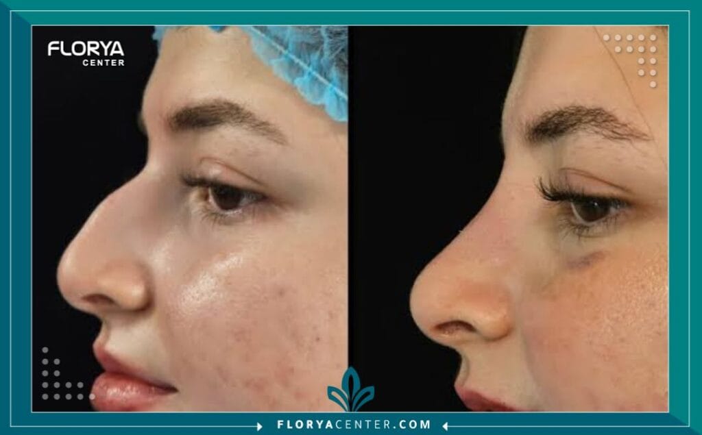 الصور داخل المقالة مها 2025 11 15T184352.237 - تجميل الأنف المغلق في تركيا يُمثل إجراء تجميل الأنف المغلق في تركيا (Closed Rhinoplasty) قمة الدقة والبراعة في عالم الجراحة التجميلية الحديثة. إذا كنت تبحث عن تحسين متناغم لملامح وجهك، أو تصحيح وظائف التنفس، دون القلق بشأن الندوب الظاهرة وفترات التعافي الطويلة، فإن هذا الإجراء هو خيارك المثالي. لقد أصبحت تركيا، وبفضل مراكز متقدمة مثل "مركز فلوريا"، الوجهة الأولى عالمياً للباحثين عن نتائج طبيعية تجمع بين الخبرة الطبية الفائقة والتكاليف المدروسة. إن تجميل الأنف المغلق في تركيا ليس مجرد عملية، بل هو استثمار دقيق في ثقتك بنفسك، حيث يتم كل التعديل من خلال شقوق مخبأة بالكامل داخل الأنف، مما يضمن مظهراً مُحسّناً دون أي أثر جراحي خارجي. بالنسبة للعديد من المرضى الدوليين، فإن تجميل الأنف المغلق في تركيا هو الحل الأمثل لتحقيق التوازن الجمالي المنشود.