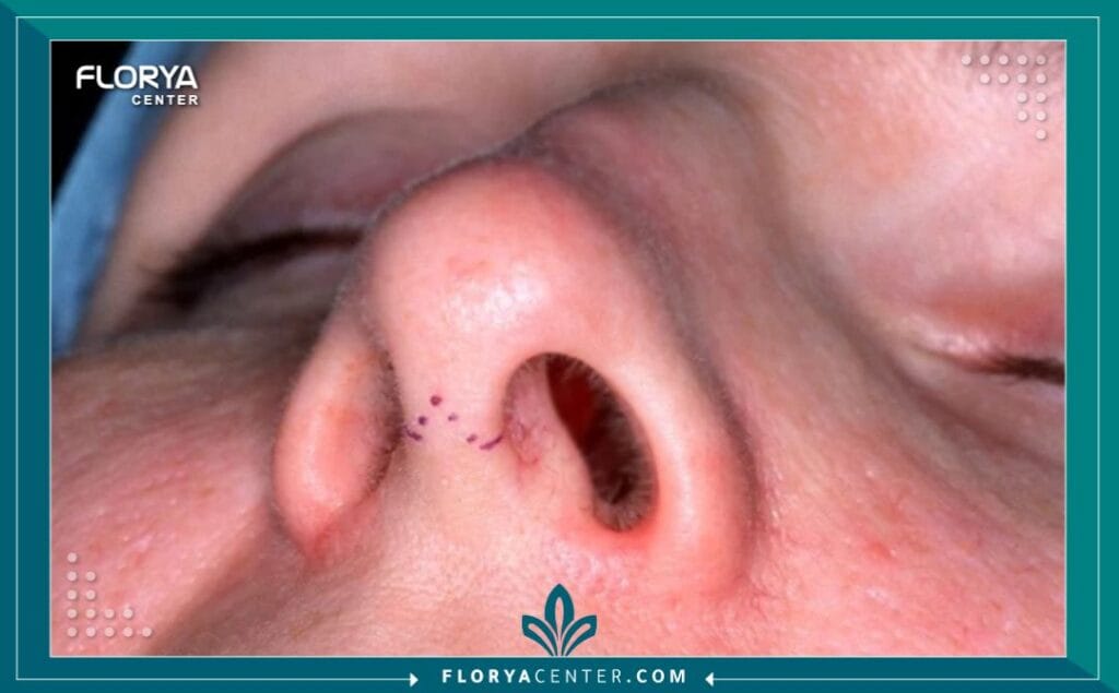 الصور داخل المقالة مها 2025 11 15T220858.504 - تجميل الأنف المفتوح في تركيا يُعد تجميل الأنف المفتوح في تركيا (Open Rhinoplasty) خياراً جراحياً متقدماً يمنح الأفراد فرصة لإعادة تعريف ملامحهم وتحقيق التناسق الوجهي الذي طالما حلموا به. في عالم يتزايد فيه الطلب على الدقة الجراحية، يبرز تجميل الأنف المفتوح في تركيا كمعيار ذهبي للتدخلات المعقدة وتصحيحات الأنف الثانوية. إنه ليس مجرد إجراء تجميلي، بل هو فن وعلم يجمع بين الرؤية الجمالية والخبرة الجراحية الفائقة، وهو ما جعل من تركيا، وخاصة اسطنبول، مركزاً عالمياً رائداً في هذا المجال.