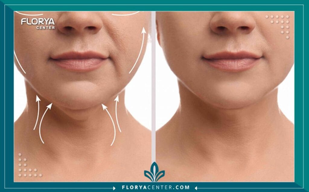 الصور داخل المقالة مها 2025 11 20T013347.157 - شد الرقبة في تركيا أصبحت شد الرقبة في تركيا (Neck Lift) اليوم واحدة من أكثر الوجهات والخيارات العلاجية جذباً للآلاف من الراغبين في استعادة مظهر الشباب والحيوية. إن عملية شد الرقبة في تركيا لا تقتصر فقط على كونها إجراءً تجميلياً، بل هي رحلة متكاملة نحو تعزيز الثقة بالنفس والتخلص من علامات التقدم في السن التي تظهر بوضوح في منطقة الرقبة والفكين. يختار المرضى من مختلف أنحاء العالم إجراء شد الرقبة في تركيا نظراً للجمع الفريد بين الخبرة الطبية العالية، والتقنيات المتطورة، والأسعار التنافسية التي لا تضاهى في أوروبا أو الولايات المتحدة.