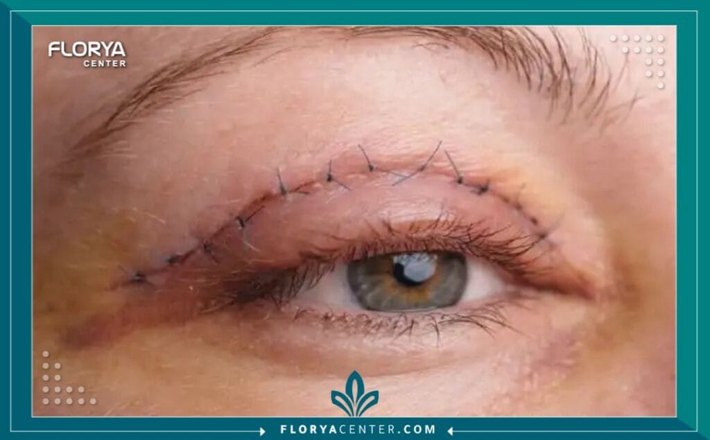 الصور داخل المقالة مها 2025 11 21T050958.606 - شد الجفون العلوية في تركيا ​تعد عملية شد الجفون العلوية في تركيا (Upper Eyelid Blepharoplasty) الحل الجراحي الذهبي لاستعادة حيوية الوجه والتخلص من علامات التقدم في السن التي تستوطن المنطقة المحيطة بالعينين أولاً. إن العين ليست مجرد "مرآة للروح"، بل هي المركز الجمالي الأول في الوجه، وأي ارتخاء في جلد الجفن العلوي قد يمنحك مظهراً يوحي بالإرهاق الدائم أو الحزن، حتى عندما تكون في قمة نشاطك. وفقاً لأحدث إحصائيات "الجمعية الدولية للجراحة التجميلية" (ISAPS) لعام 2024، قفزت معدلات إجراء جراحات الجفون بنسبة تجاوزت 13.4% عالمياً، لتصبح الإجراء التجميلي الأكثر طلباً متفوقةً حتى على شفط الدهون، مما يعكس توجهاً عالمياً نحو الحفاظ على نظرة شابة وطبيعية.