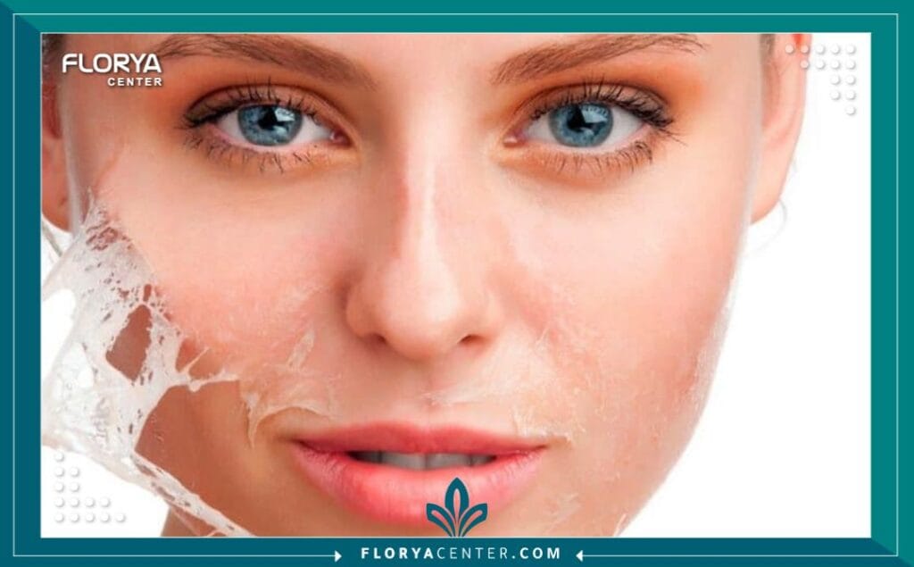 التقشير الكيميائي للوجه في تركيا 5 الصور داخل المقالة مها 2025 11 25T044854.614 - التقشير الكيميائي للوجه في تركيا هل تشعرين بالحزن كلما نظرتِ في المرآة ورأيتِ آثار الزمن أو حب الشباب قد سرقت نضارتك؟ إن التقشير الكيميائي للوجه في تركيا (Chemical Face Peel) ليس مجرد إجراء تجميلي سطحي، بل هو بوابتك الزمنية لاستعادة الثقة وإشراقة الشباب المفقودة، حيث يمثل حلاً جذرياً يعيد بناء بشرتك من جديد. في عالم الطب التجميلي، يعتبر هذا الإجراء "المعيار الذهبي" لتجديد الخلايا، وقد أصبح الوجهة الأولى للآلاف حول العالم. في هذا الدليل، سنغوص في أعماق هذا الإجراء، مستندين إلى أحدث الأبحاث الطبية والخبرات السريرية، لنشرح لكِ لماذا يعتبر التقشير الكيميائي للوجه في تركيا الخيار الأمثل لتحقيق التحول الذي تحلمين به.