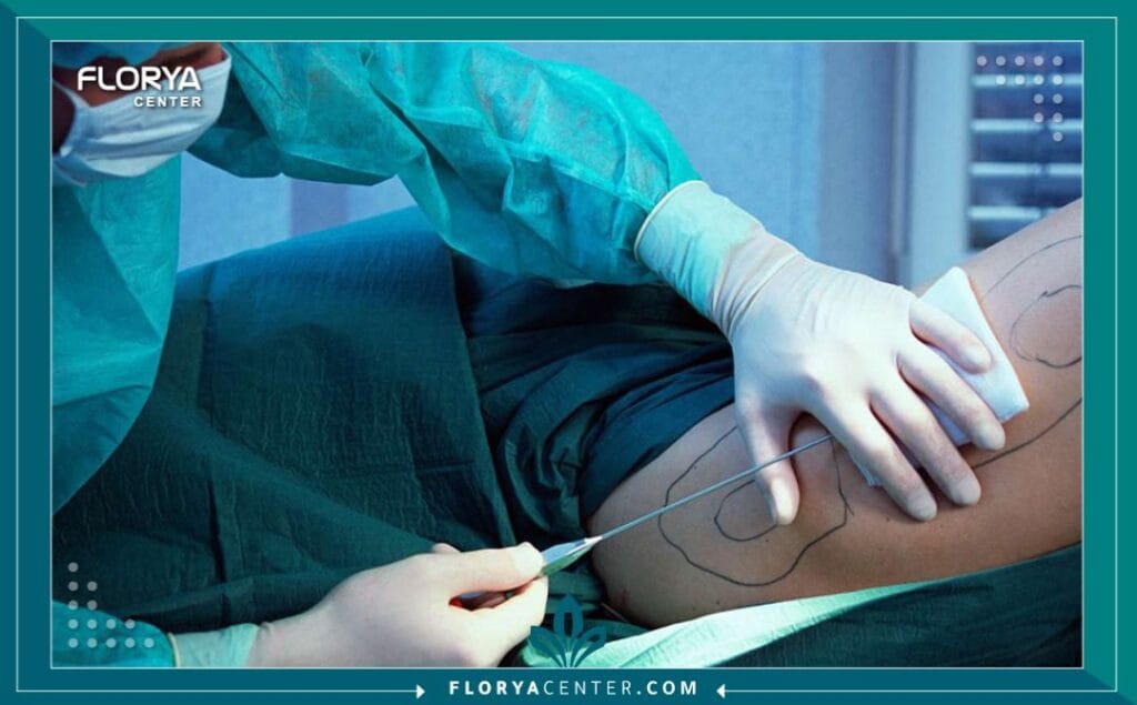 الصور داخل المقالة مها 3 - شفط دهون الفخذين في تركيا إن السعي للحصول على قوام متناسق ومثالي هو رحلة يبحث فيها الكثيرون عن التناغم بين أجزاء الجسم المختلفة. يعتبر إجراء شفط دهون الفخذين في تركيا (Thigh Liposuction) الحل الأمثل والأكثر تقدماً لأولئك الذين يعانون من تراكم الدهون العنيدة في منطقة الفخذين، والتي غالباً ما تقاوم أقسى الحميات الغذائية والتمارين الرياضية. إن إجراء شفط دهون الفخذين في تركيا لا يقتصر على إزالة الدهون فحسب، بل هو فن دقيق لـ نحت الجسم، يهدف إلى استعادة الثقة بالنفس، ومنح الفخذين مظهراً مشدوداً وجذاباً يتناسب مع بقية ملامح الجسم. في عالم اليوم، أصبح الحصول على هذا التناسق ممكناً أكثر من أي وقت مضى، خاصة مع الخبرات الطبية المتقدمة التي تقدمها مراكز رائدة مثل "مركز فلوريا".