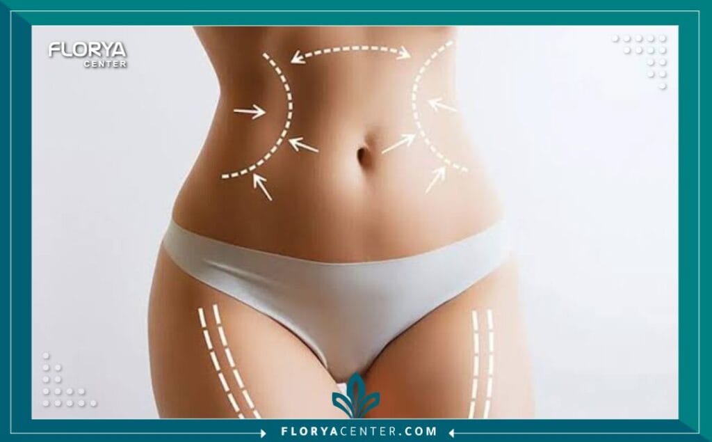 الصور داخل المقالة مها 48 1 - شفط دهون البطن والظهر في تركيا يُعد إجراء شفط دهون البطن والظهر في تركيا اليوم ثورة في عالم نحت القوام، مقدماً حلاً مثالياً للأشخاص الذين يسعون للتخلص من الدهون العنيدة في منطقتي الجذع (البطن والظهر) والتي غالباً ما تقاوم الحميات الغذائية والتمارين الرياضية. إن التفكير في شفط دهون البطن والظهر (Liposuction of the abdomen and back) لم يعد مجرد رفاهية، بل هو خطوة استراتيجية لاستعادة الثقة بالنفس والحصول على قوام متناسق. وتبرز تركيا، وتحديداً مدينة إسطنبول، كوجهة أولى عالمياً لإجراء شفط دهون البطن والظهر في تركيا، بفضل التكلفة المنافسة، الخبرات الطبية الفائقة، والمراكز المجهزة بأحدث التقنيات مثل "مركز فلوريا".