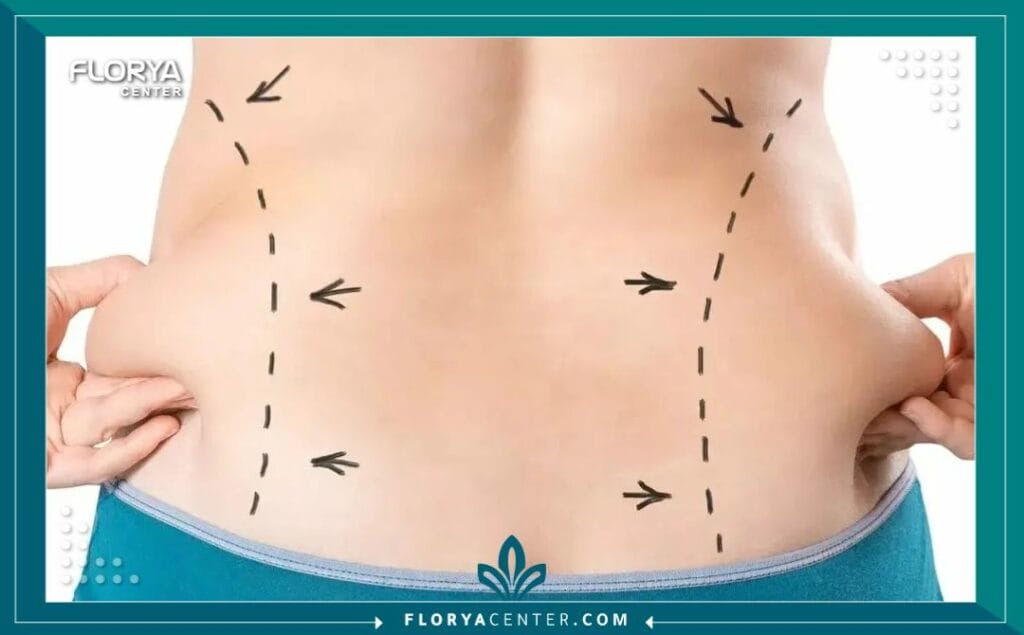 الصور داخل المقالة مها 52 - شفط دهون البطن والظهر في تركيا يُعد إجراء شفط دهون البطن والظهر في تركيا اليوم ثورة في عالم نحت القوام، مقدماً حلاً مثالياً للأشخاص الذين يسعون للتخلص من الدهون العنيدة في منطقتي الجذع (البطن والظهر) والتي غالباً ما تقاوم الحميات الغذائية والتمارين الرياضية. إن التفكير في شفط دهون البطن والظهر (Liposuction of the abdomen and back) لم يعد مجرد رفاهية، بل هو خطوة استراتيجية لاستعادة الثقة بالنفس والحصول على قوام متناسق. وتبرز تركيا، وتحديداً مدينة إسطنبول، كوجهة أولى عالمياً لإجراء شفط دهون البطن والظهر في تركيا، بفضل التكلفة المنافسة، الخبرات الطبية الفائقة، والمراكز المجهزة بأحدث التقنيات مثل "مركز فلوريا".