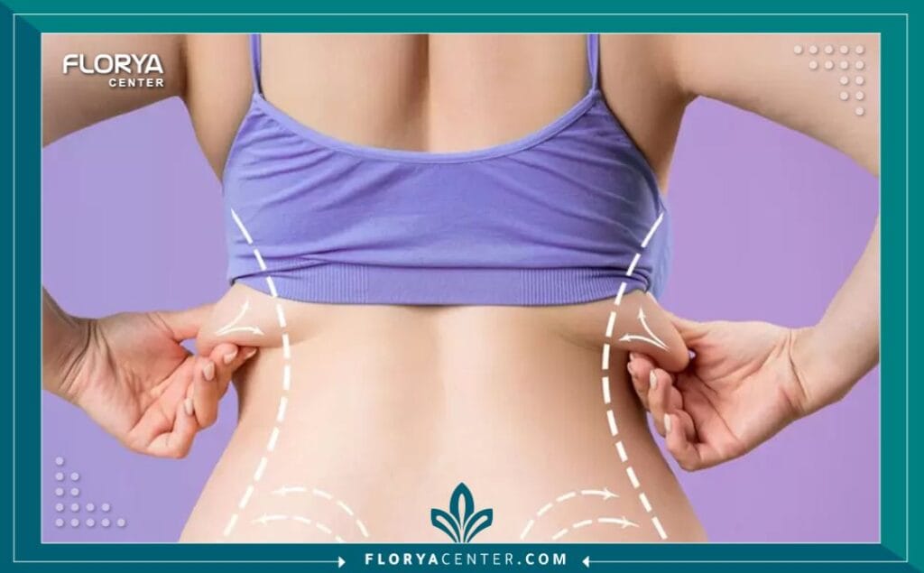 الصور داخل المقالة مها 53 - شفط دهون البطن والظهر في تركيا يُعد إجراء شفط دهون البطن والظهر في تركيا اليوم ثورة في عالم نحت القوام، مقدماً حلاً مثالياً للأشخاص الذين يسعون للتخلص من الدهون العنيدة في منطقتي الجذع (البطن والظهر) والتي غالباً ما تقاوم الحميات الغذائية والتمارين الرياضية. إن التفكير في شفط دهون البطن والظهر (Liposuction of the abdomen and back) لم يعد مجرد رفاهية، بل هو خطوة استراتيجية لاستعادة الثقة بالنفس والحصول على قوام متناسق. وتبرز تركيا، وتحديداً مدينة إسطنبول، كوجهة أولى عالمياً لإجراء شفط دهون البطن والظهر في تركيا، بفضل التكلفة المنافسة، الخبرات الطبية الفائقة، والمراكز المجهزة بأحدث التقنيات مثل "مركز فلوريا".