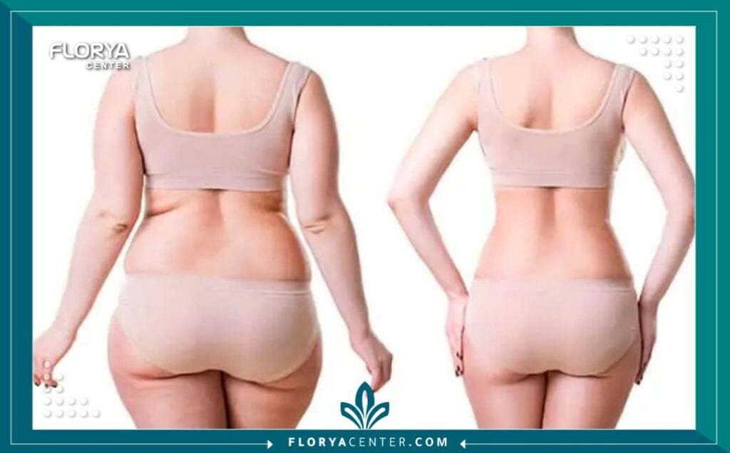 الصور داخل المقالة مها 54 - شفط دهون البطن والظهر في تركيا يُعد إجراء شفط دهون البطن والظهر في تركيا اليوم ثورة في عالم نحت القوام، مقدماً حلاً مثالياً للأشخاص الذين يسعون للتخلص من الدهون العنيدة في منطقتي الجذع (البطن والظهر) والتي غالباً ما تقاوم الحميات الغذائية والتمارين الرياضية. إن التفكير في شفط دهون البطن والظهر (Liposuction of the abdomen and back) لم يعد مجرد رفاهية، بل هو خطوة استراتيجية لاستعادة الثقة بالنفس والحصول على قوام متناسق. وتبرز تركيا، وتحديداً مدينة إسطنبول، كوجهة أولى عالمياً لإجراء شفط دهون البطن والظهر في تركيا، بفضل التكلفة المنافسة، الخبرات الطبية الفائقة، والمراكز المجهزة بأحدث التقنيات مثل "مركز فلوريا".