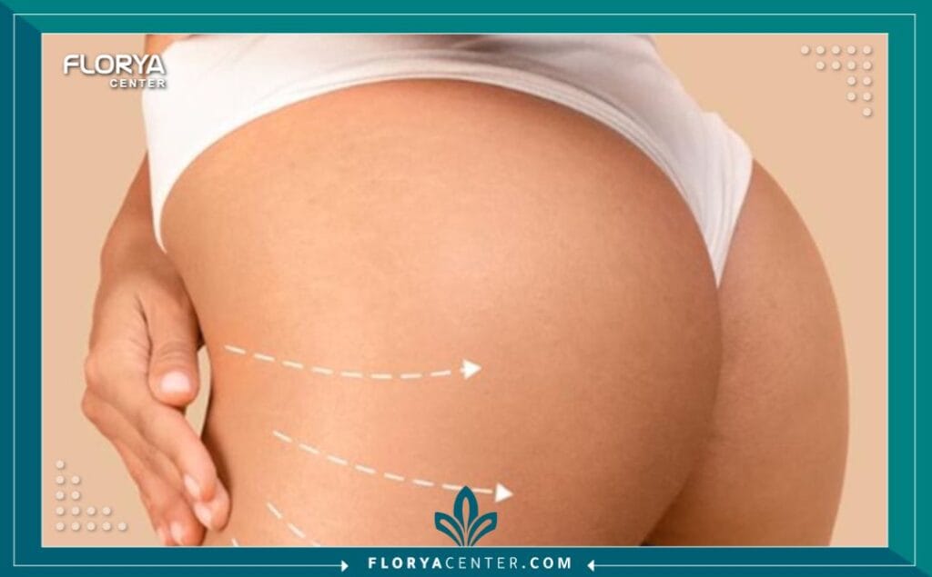 شفط دهون الأرداف والفخذين في تركيا 3 الصور داخل المقالة مها 58 - شفط دهون الأرداف والفخذين في تركيا تعتبر عملية شفط دهون الأرداف والفخذين في تركيا (Liposuction of the hips and thighs) من أكثر الإجراءات التجميلية تطوراً وطلباً، حيث تقدم حلاً جذرياً لنحت المنطقة السفلية من الجسم والتخلص من الدهون الموضعية العنيدة التي لا تستجيب للأنظمة الغذائية أو التمارين الرياضية. إذا كنتم تبحثون عن استعادة التناسق والثقة بمظهركم، فإن شفط دهون الأرداف والفخذين في تركيا يمثل المسار الأمثل، خاصة عند إجرائه في مراكز متخصصة مثل "مركز فلوريا" الذي يجمع بين الخبرة الطبية الفائقة وأحدث التقنيات لضمان نتائج مبهرة وطبيعية. إن السعي نحو الجسم المثالي يبدأ بخطوة مدروسة، وشفط دهون الأرداف والفخذين في تركيا هو تلك الخطوة.