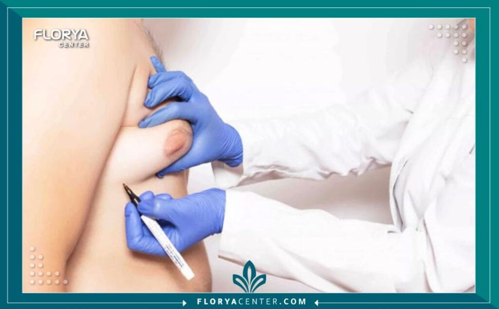 الصور داخل المقالة مها 60 - شفط دهون التثدي للرجال في تركيا يُعد شفط دهون التثدي للرجال في تركيا الحل الأمثل والأكثر تطوراً للرجال الذين يعانون من تضخم الثدي، وهي حالة شائعة ولكنها مُحرجة نفسياً. إن السعي للحصول على مظهر صدر أكثر ذكورية وثباتاً هو حق مشروع، وقد أثبتت التجربة التركية في مجال التجميل ريادتها في تقديم حلول جذرية. إن عملية شفط دهون التثدي للرجال في تركيا لا تقتصر على إزالة الدهون أو الأنسجة الغدية، بل هي خطوة نحو استعادة الثقة بالنفس، وذلك باستخدام أحدث التقنيات الجراحية الدقيقة (Gynecomastia Surgery) التي تضمن نتائج طبيعية ودائمة.