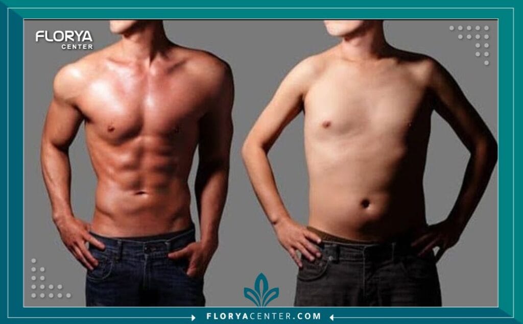 الصور داخل المقالة مها 71 - شد عضلات البطن في تركيا ​يُعد إجراء شد عضلات البطن في تركيا (Abdominoplasty) واحداً من أكثر الحلول الجراحية فعالية لاستعادة مظهر بطن مسطح ومشدود. مع التغيرات الكبيرة التي قد تطرأ على الجسم بسبب الحمل، أو فقدان الوزن الكبير، أو حتى التقدم الطبيعي في السن، قد تصبح عضلات البطن ضعيفة ويترهل الجلد، مما يسبب إزعاجاً جمالياً ونفسياً للكثيرين. تهدف هذه الجراحة إلى معالجة هذه التغيرات، وإزالة الجلد الزائد والدهون، وإصلاح العضلات المنفصلة، مما يمنحك القوام المتناسق الذي تطمح إليه ويعزز ثقتك بنفسك.