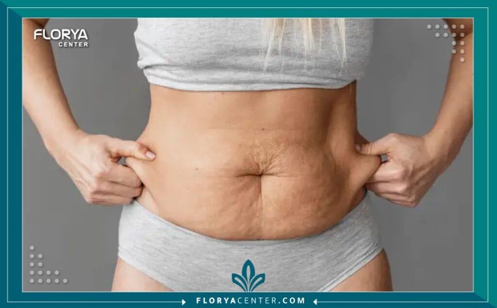 الصور داخل المقالة مها 76 - شد البطن الكامل في تركيا يُعد إجراء شد البطن الكامل في تركيا (Abdominoplasty) ثورة حقيقية في عالم الجراحة التجميلية، مقدماً حلاً مثالياً للآلاف ممن يسعون لاستعادة مظهر بطن مشدود ومسطح. مع تزايد الوعي بأهمية تناسيق الجسم وتأثيره على الثقة بالنفس، أصبح هذا الإجراء واحداً من أكثر العمليات طلباً على مستوى العالم.