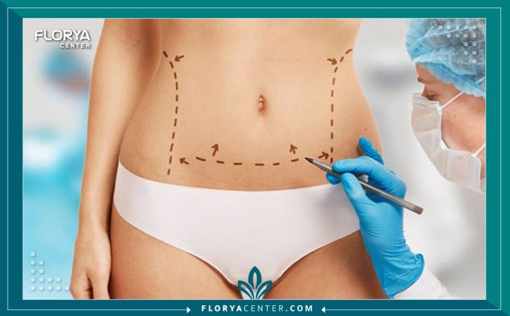 الصور داخل المقالة مها 77 - شد البطن الكامل في تركيا يُعد إجراء شد البطن الكامل في تركيا (Abdominoplasty) ثورة حقيقية في عالم الجراحة التجميلية، مقدماً حلاً مثالياً للآلاف ممن يسعون لاستعادة مظهر بطن مشدود ومسطح. مع تزايد الوعي بأهمية تناسيق الجسم وتأثيره على الثقة بالنفس، أصبح هذا الإجراء واحداً من أكثر العمليات طلباً على مستوى العالم.