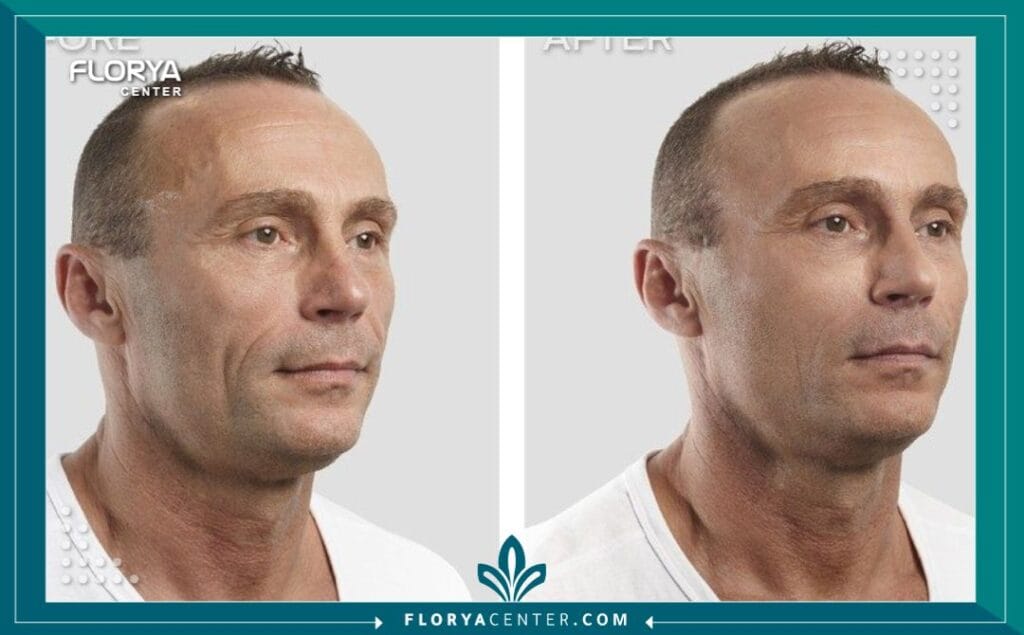 الصور داخل المقالة مها 80 - عمليات الشد الجراحية في تركيا تُعتبر عمليات الشد الجراحية في تركيا (Surgical Lift Procedures in Turkey) اليوم معياراً ذهبياً للباحثين عن استعادة الشباب وتجديد المظهر بثقة وجودة عالية. لم يعد التقدم في السن أو تأثيرات الجاذبية عائقاً دائماً أمام الحصول على مظهر مشدود وحيوي. مع التطور الهائل في التقنيات الطبية والخبرات الجراحية المتراكمة، تقدم تركيا، وتحديداً اسطنبول، حلولاً متكاملة تجمع بين الدقة الطبية الفائقة والتكاليف التنافسية. لم تعد هذه الإجراءات مجرد رفاهية، بل هي استثمار مدروس في الذات، يهدف إلى مواءمة المظهر الخارجي مع الروح الشابة في الداخل، وهو ما يبرع فيه جراحو التجميل الأتراك بفضل رؤيتهم الفنية وخبرتهم العميقة.